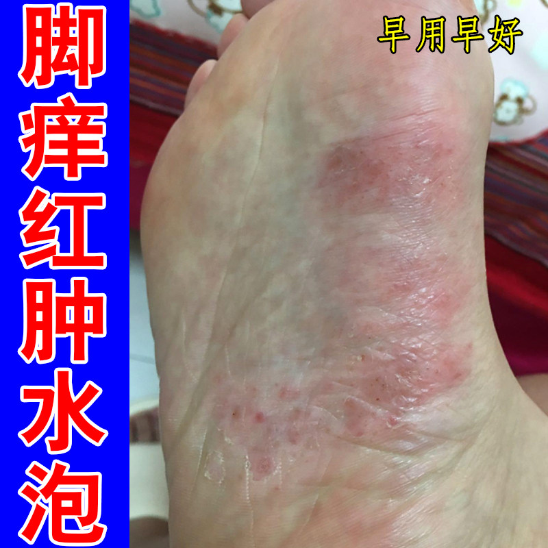 脚痒红肿水泡脚底干燥脱屑起鳞屑脚趾缝痒裂口感染蜕皮脚出汗修护