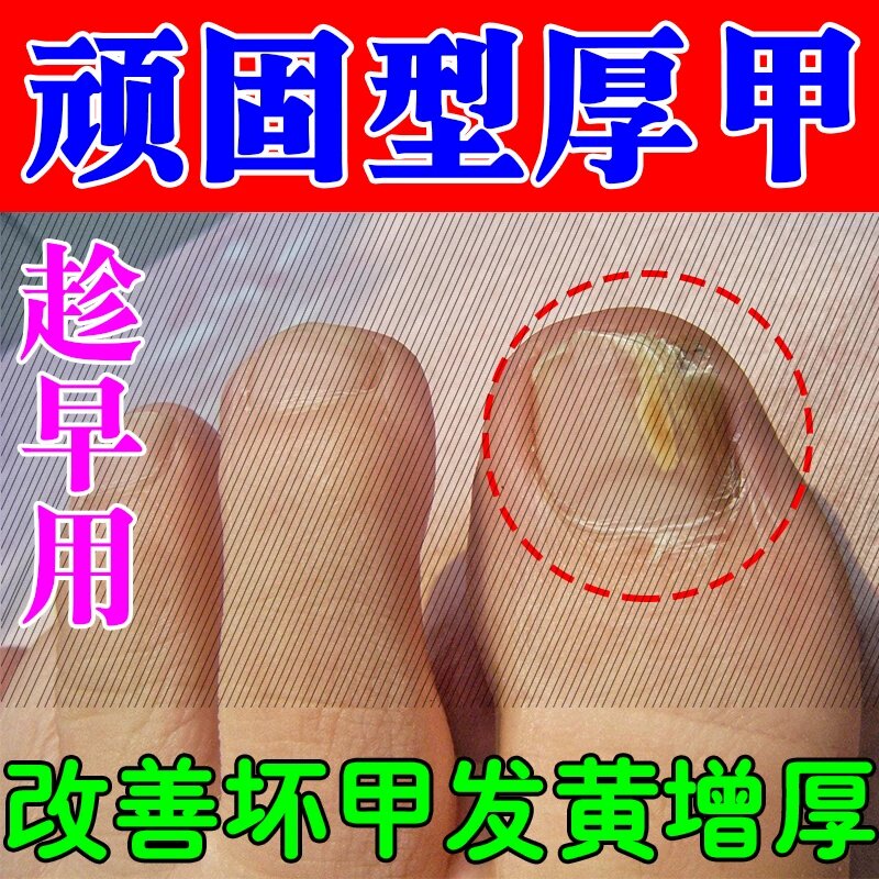 脚指甲发黄变厚变硬真菌性白甲脚指甲发黄变厚增厚空甲肉床分离