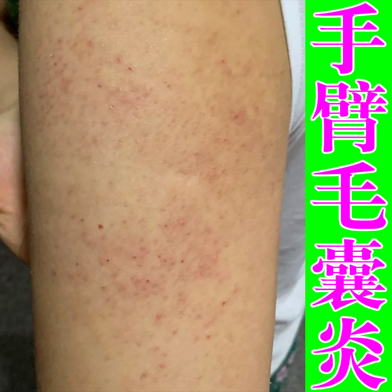手臂毛囊疙瘩胳膊上的小疙瘩毛囊堵塞脂溢性日本进口