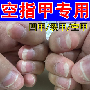 空指甲专用指甲萎缩分层凹凸不平裂口干燥变黄指甲变脆冶坏甲空甲