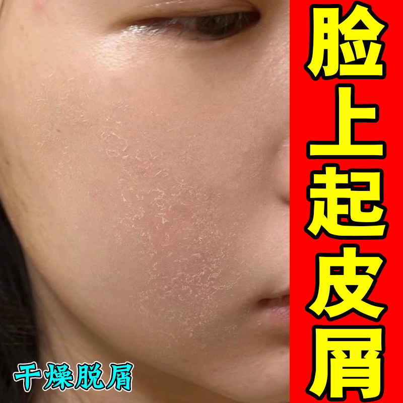 脸干燥起皮泛红过敏面霜修复药乳