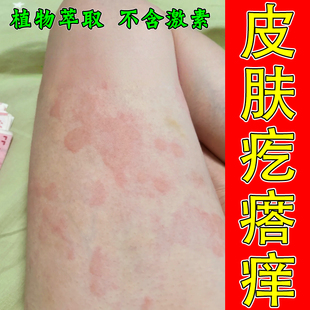 皮肤疙瘩痒老年人身上干痒专用小腿上起皮掉屑鳞屑冬天小腿红斑点