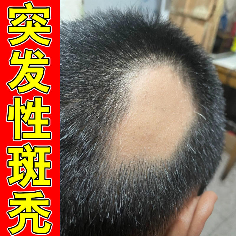 斑秃块状掉发头发稀疏发根养护日常调理草本滋养头皮护理液改善剂