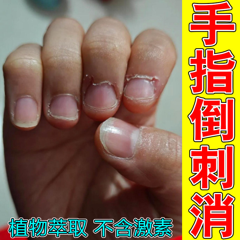 手指倒刺消肉刺指甲边缘起死皮表皮撕裂角质层裂口手部皮肤干燥霜