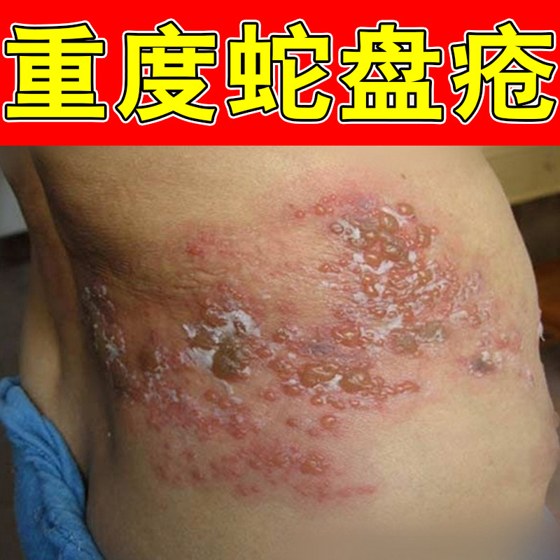 缠腰龙皮肤不适护理身体单侧成簇水泡肌肤泛红刺痒日常皮肤外用膏