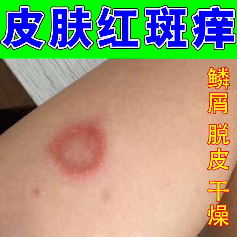 身上长红斑红疙瘩痒猫专用皮肤红肿痒起圆猫咪传染猫人得猫药乳膏