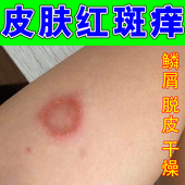 身上长红斑红疙瘩痒猫专用皮肤红肿痒起圆猫咪传染猫人得猫药乳膏