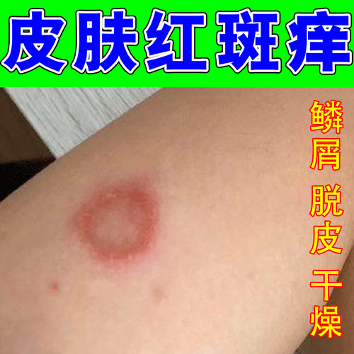 身上长红斑红疙瘩痒猫专用皮肤红肿痒起圆猫咪传染猫人得猫药乳膏