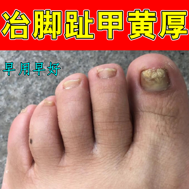冶脚趾甲黄厚指甲发黄感染真菌性白甲空甲甲肉分离黑线甲萎缩分离