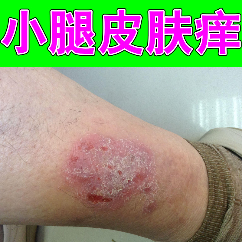 小腿皮肤痒掉屑红肿季节性过敏老皮肤消毒护理（消）