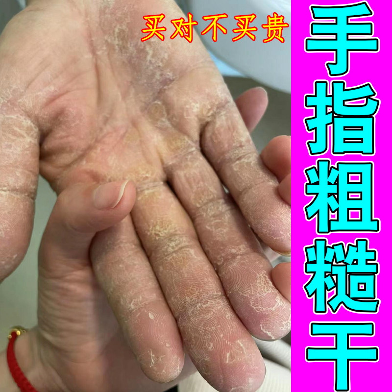 手指粗糙干角化型手干裂皮肤过敏换季指关节起硬疙瘩去角质修护膏