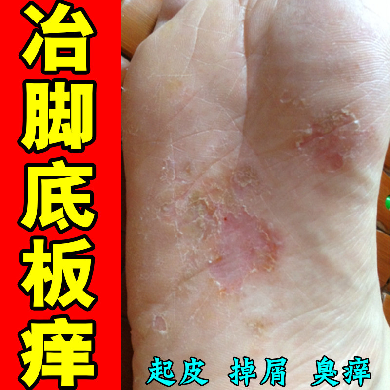 脚底皮肤粗糙干燥角质增厚修复药