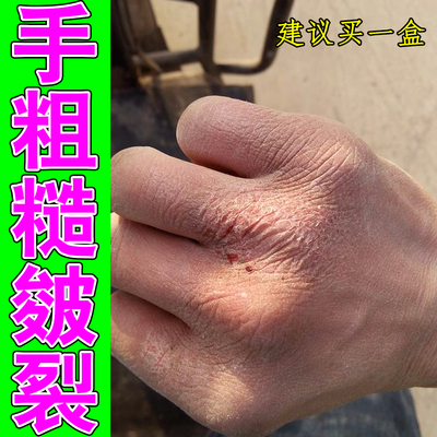 手背干裂起皮粗糙发硬角质堆积纹路杂乱泛红脱皮脱屑紧绷干涩滋润