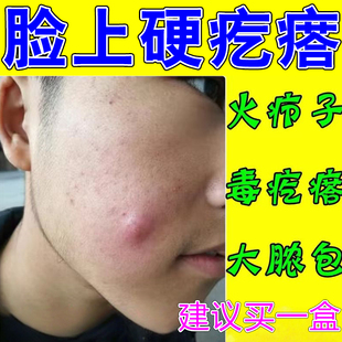 火疖子脸上起硬块大包痘痘流脓化脓皮肤红肿痒外用神器拔脓膏