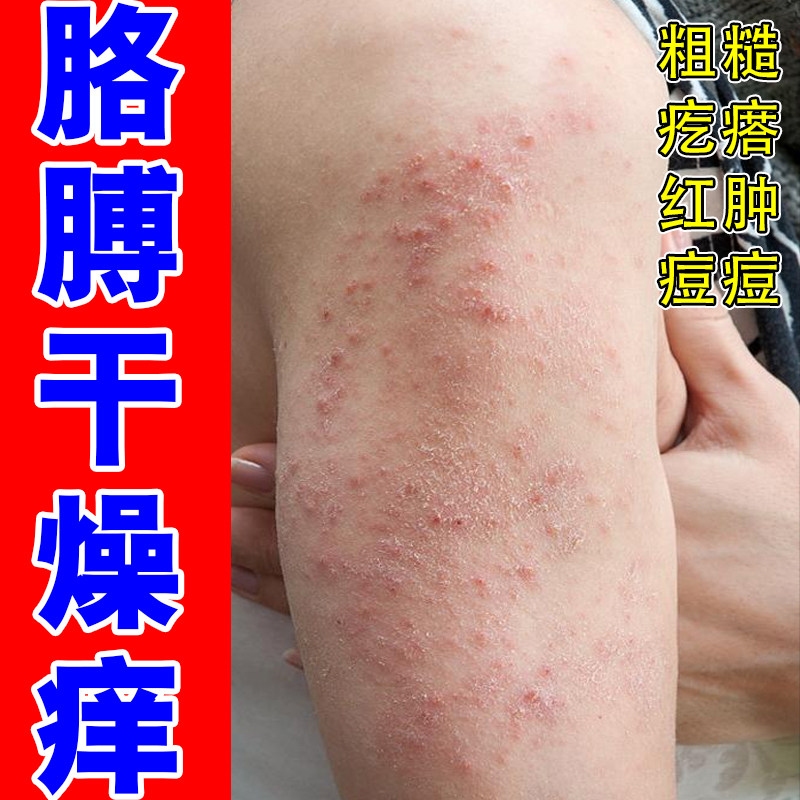 胳膊干燥粗糙痒起皮鳞屑长红点皮肤过敏痒长痘痘疹子外用草本修复