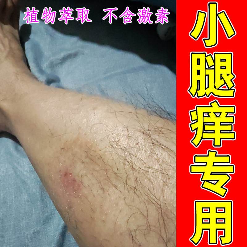 小腿痒专用皮肤干燥粗糙掉屑神经性过敏痒长红疙瘩屁股痘大腿内侧