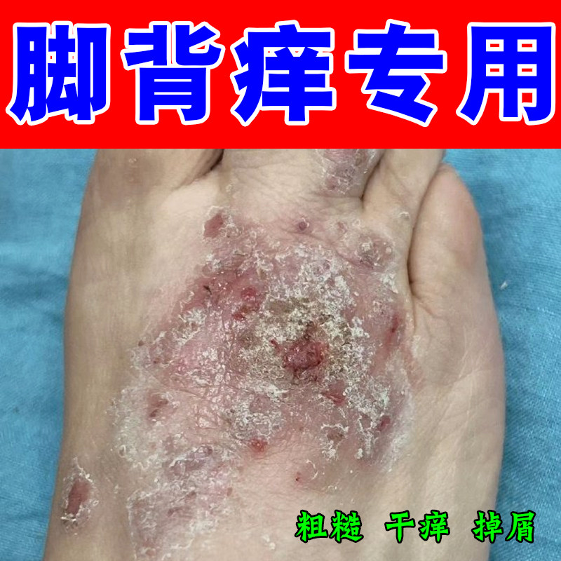 冶脚背干燥长红疙瘩红斑起皮掉屑脚上起红点红肿刺挠膏药