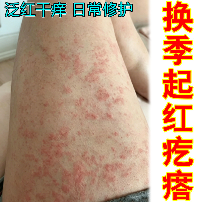 皮肤过敏痒药乳膏换季身上起红疙瘩红点干燥粗糙外用修护软膏