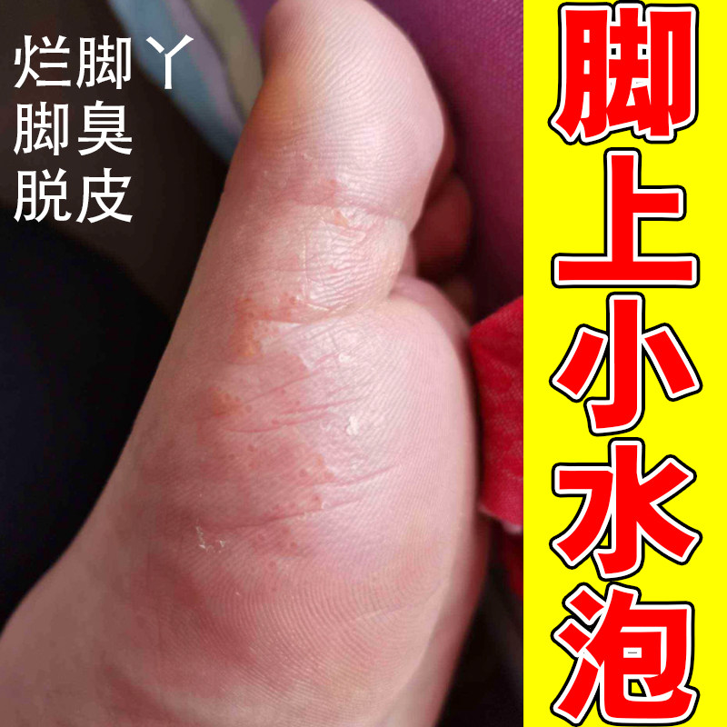 脚上长小水泡脱皮糜烂脚底修复药