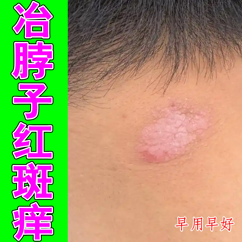 冶脖子红斑痒颈部红痒脖颈一圈红斑红肿过敏痒掉屑粗糙干燥外用膏