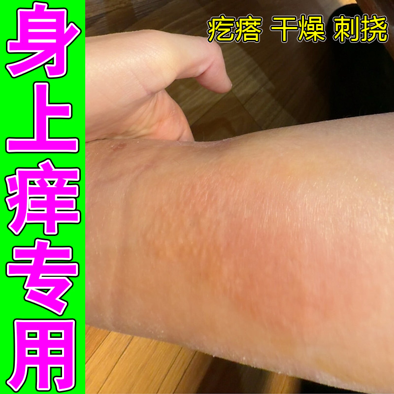 身上痒专用皮肤疙瘩粗糙干燥起红点紫外线过敏神经性换季修护药乳