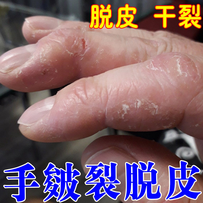 手脱皮干裂真菌感染蜕皮儿童手指起干皮手皴裂手足起硬皮修复