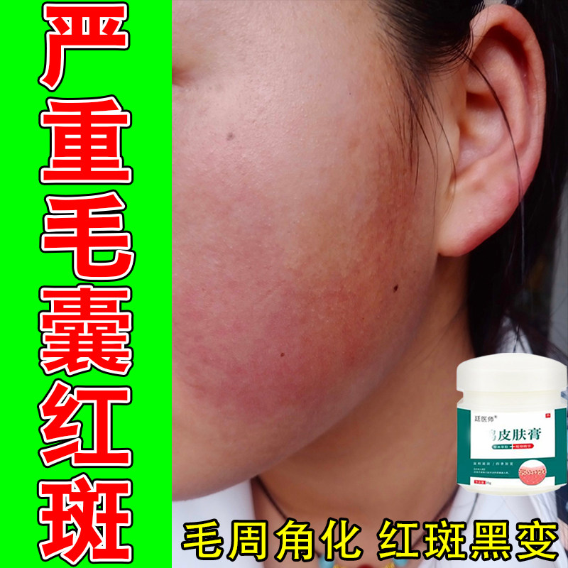脸上毛囊红斑黑变毛周角化脸颊疙瘩皮肤粗糙暗沉变黑变黑修护膏