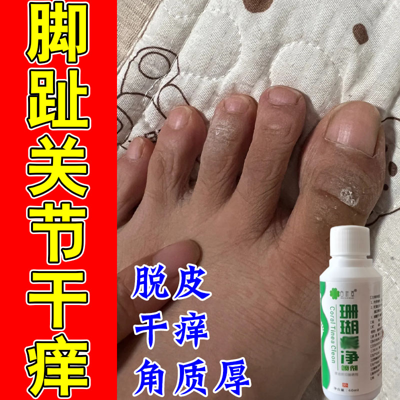 冶脚趾头上长痒脚趾关节粗糙干燥屑起皮脱皮痒红结痂修护膏