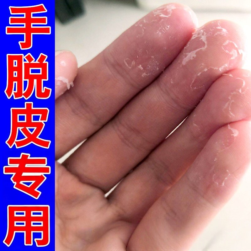 手脱皮严重脱皮专用真菌蜕皮干燥起皮膏治护手霜脱皮脚底开裂