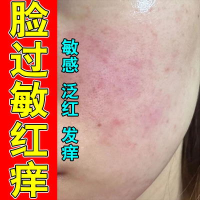 冶敏感脸上干燥起皮过敏发红脸部泛红敏感刺痛草本修护膏
