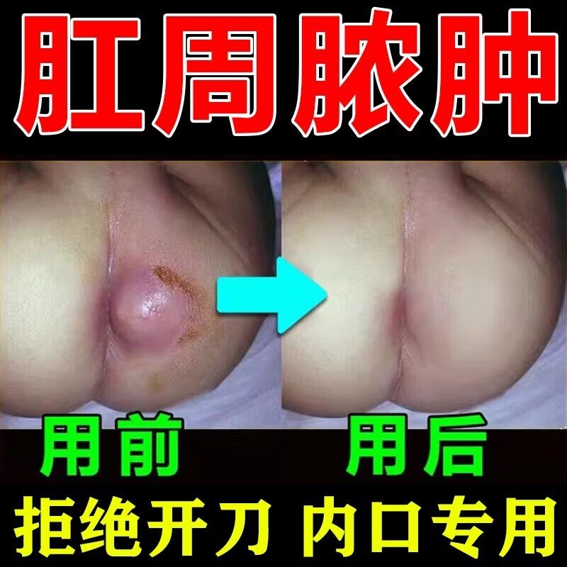 肛瘘封口膏内口外口专用的特肛便血治疗肛周脓肿愈合凝胶