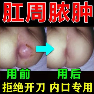 肛瘘封口膏内口外口专用的特肛便血治疗肛周脓肿愈合凝胶