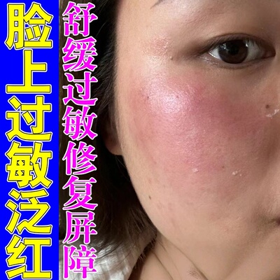 脸部过敏皮肤修复过敏痒红肿面部干燥起皮屑痒激素脸排毒的软膏