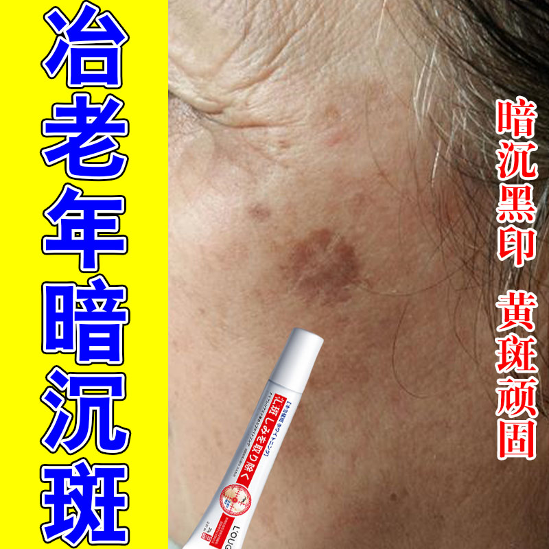 老年脸上斑脸部手部黑斑晒斑黄斑雀斑黑板皮肤修护白均匀草本膏