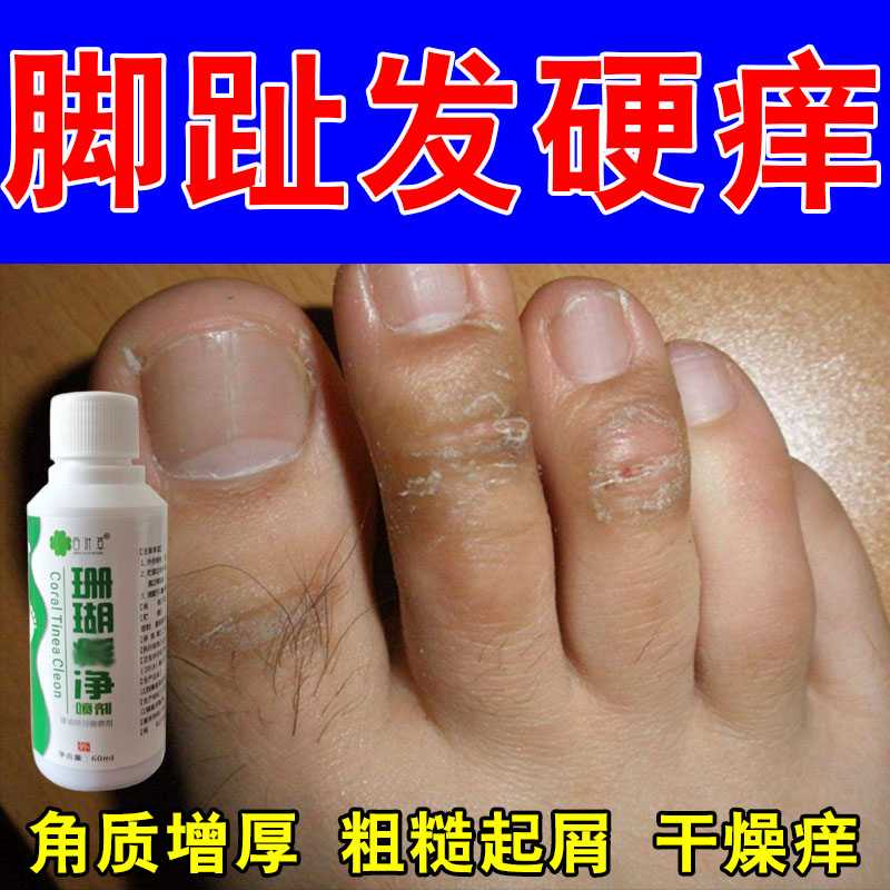 脚趾关节硬皮长痒脚指头干燥起硬皮脱屑脚背面皮肤粗糙专用膏