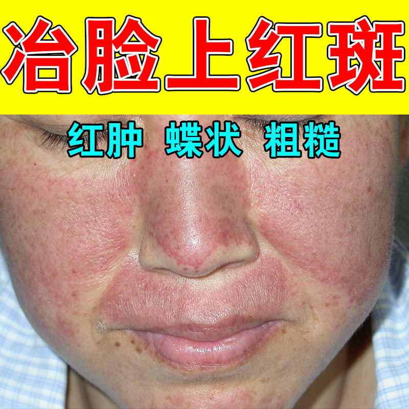 面部蝶形红斑脸部泛红敏感受损皮肤舒缓保湿草本萃取舒缓膏