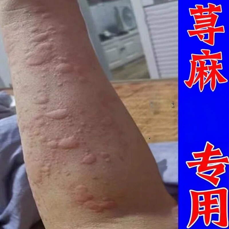 严重麻全身皮肤干/痒菌过敏风团一抓疙瘩痒外用痒乳膏