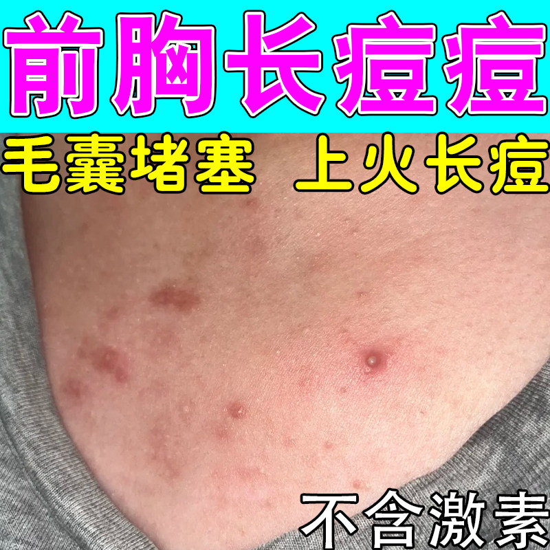前胸痘肿后背长痘毛囊背部起疙瘩红肿毛囊堵塞粗糙痒修护保湿膏