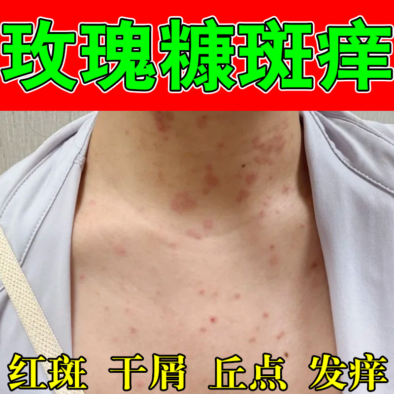 玫瑰红斑皮肤起红斑粗糙干痒身上红斑起干屑红斑痒修护草本软膏