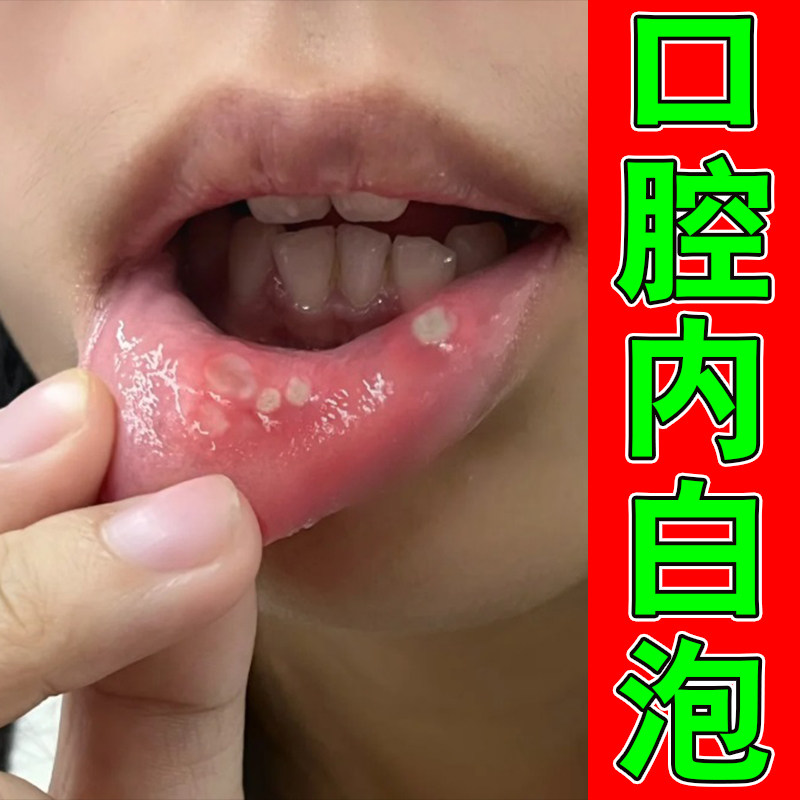 内壁口腔专用喷雾剂上火起泡黏膜修护非口腔抗真菌修复草本喷剂