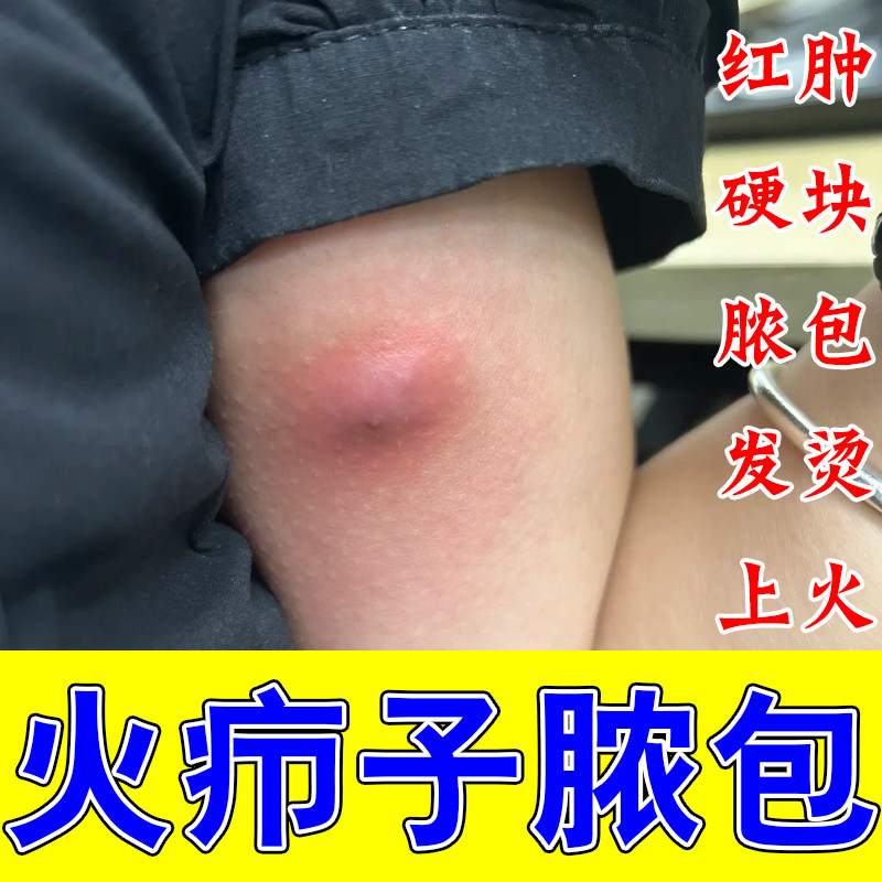 冶身上长火疖子红肿严重红疙瘩硬块上火火疖子化脓修护舒缓膏乳