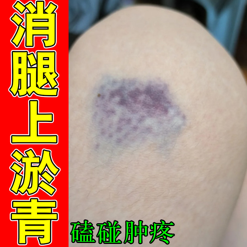 腿上淤青消活血化瘀膝盖摔磕撞伤发紫跌打损伤肿疼外用淤青膏