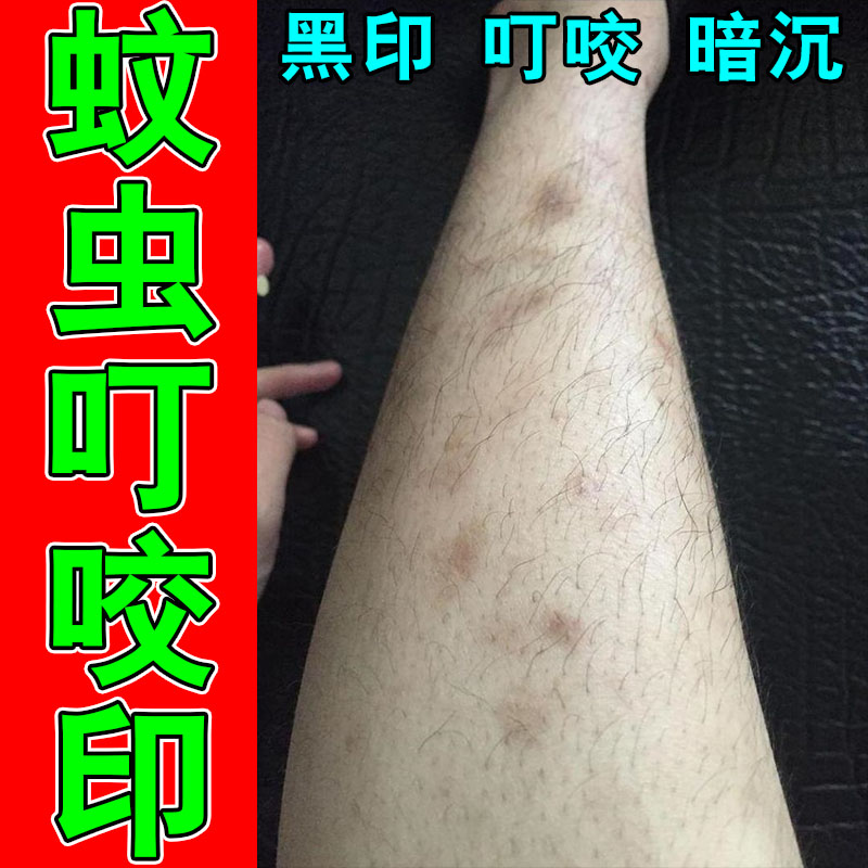 蚊虫叮咬疤痕黑印明显疤印深色黑色素沉淀积雪草修复按摩膏