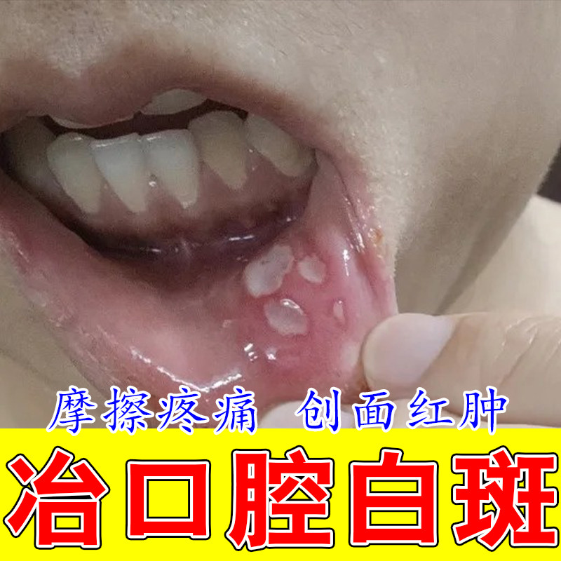 口腔长白斑上火黏膜疼痛嘴巴舌头起泡缺乏维生素口腔草本修护喷剂