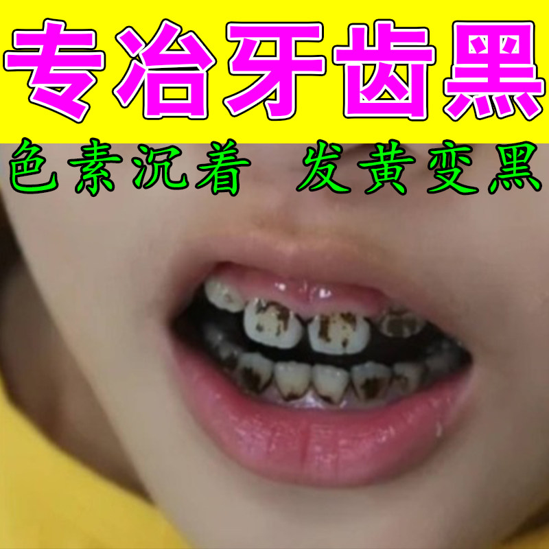 严重牙齿发黑牙黄有烟渍茶渍牙根发黑牙菌斑牙齿黄黑净牙液