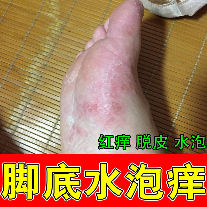 脚底上起小水泡干痒起皮干燥粗糙发痒水泡脚起皮真菌草本软膏