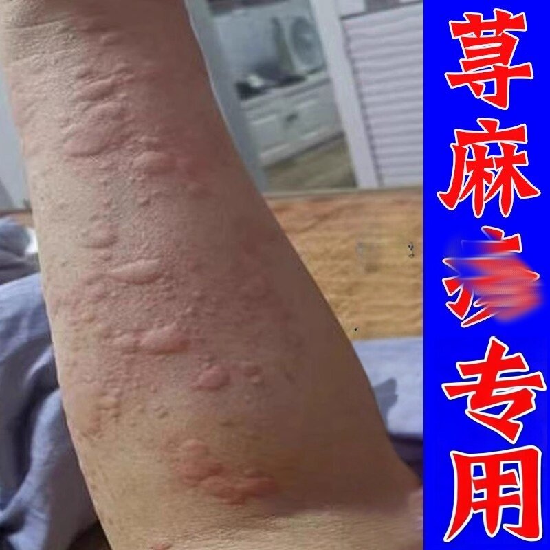 严重荨麻全身皮肤干/痒菌过敏风团一抓起疙瘩痒外用痒乳膏