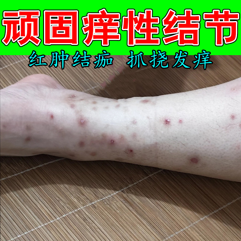 结节性痒红硬疙瘩严重硬疙瘩皮肤粗糙发黑变硬疙瘩发痒结痂膏