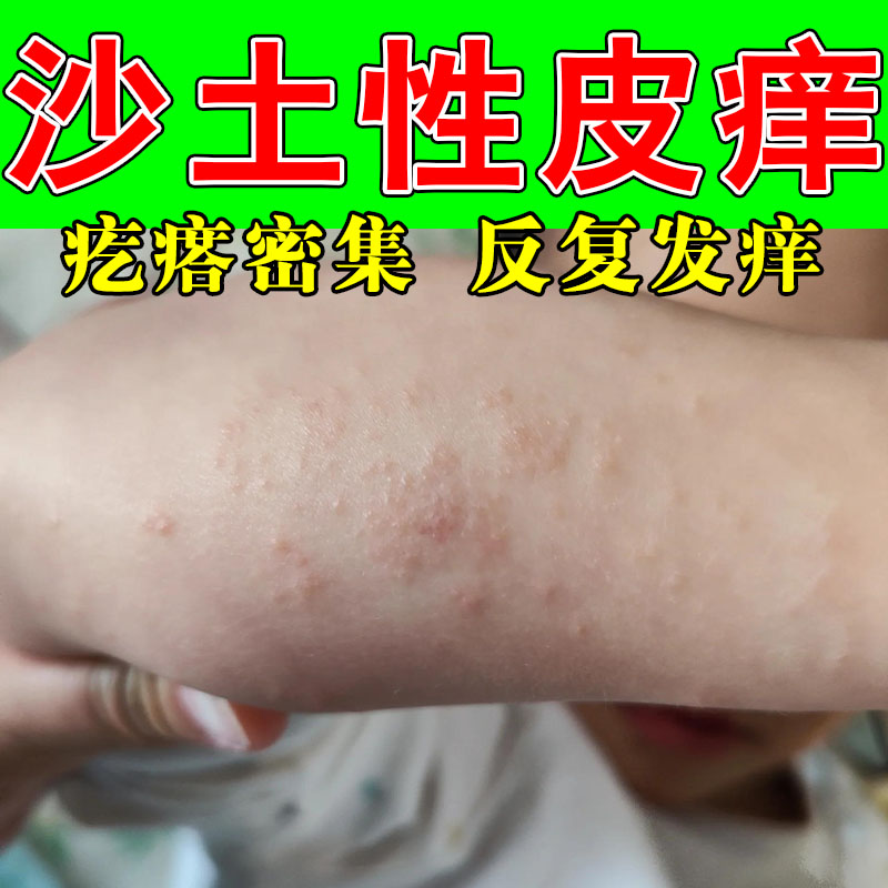 儿童沙土性摩擦疙瘩日光过敏改善手背手腕起小疙瘩草本舒缓乳膏
