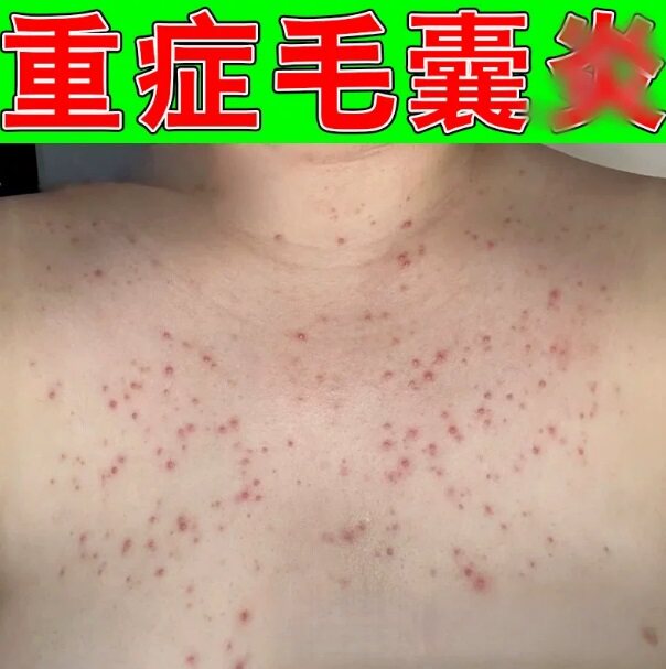 前胸后背长痘痘治马拉色菌毛囊后背脓包疙瘩去除螨虫专用膏